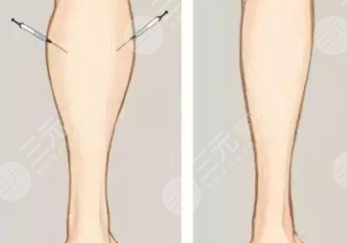 小腿吸脂后多久可以正常走路？