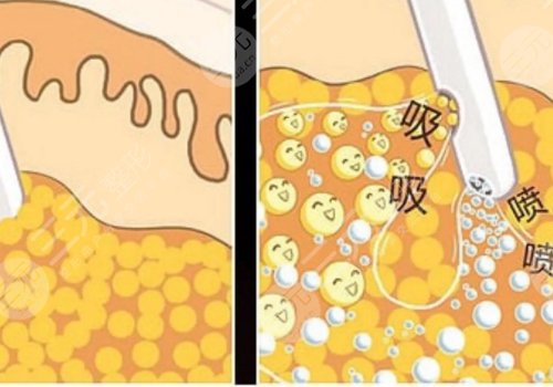 小腿吸脂后多久可以正常走路？