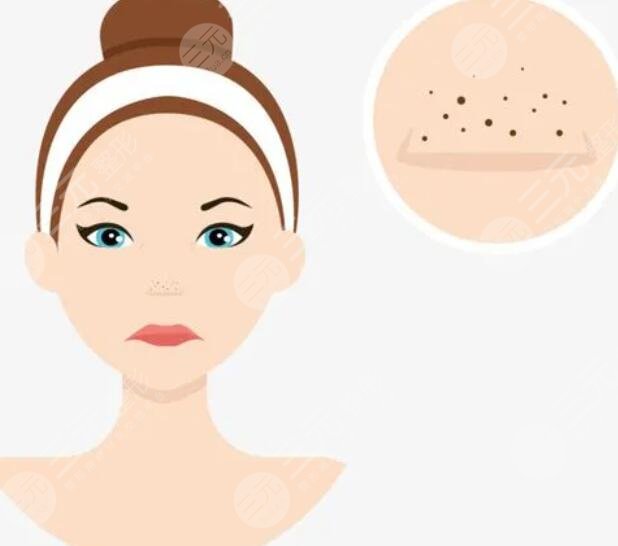 　　如何收縮鼻頭毛孔?衰老真的是一件可怕的事情。不管一個人看起來有多好，總有一天他會變老，表現(xiàn)在容貌上就是每個人鼻子上都有黑頭和毛孔，然后得心應(yīng)手的習慣就是把黑頭擠出來，然后鼻頭上全是小孔，其實那是毛孔，要學(xué)會清潔鼻頭，收縮毛孔。今天們就來談?wù)動行陬^、縮小毛孔的問題，繼而美白肌膚，使肌膚光澤柔和透明。以下方法趕緊學(xué)起來吧。  　　1、用油熔融油去除黑頭  　　(1)以手和臉都干燥為前提，將適量的按摩油滴在手掌上涂在臉上。  　　(2)用蒸毛巾或熱水熏蒸3分鐘，充分打開毛孔。  　　(3)將按摩油滴到指腹上，在有黑頭的部位加上圈的手法，輕輕揉10分鐘左右。  　　(4)用紙巾或棉花擦去多余的皮脂后，用洗面奶清潔臉部。  　　(5)拍完化妝水后，戴上收縮毛孔的面膜，可以徹底清潔毛孔去除黑頭。  　　2、日常護理工作  　　(1)使用富含果酸和水楊酸成分的洗面奶能收縮大毛孔的好潔面產(chǎn)品。請記住不要使用高強度的洗面奶。否則，效果會適得其反，破壞皮脂表層，使皮膚干燥，身體反而會分泌大量油脂保護表皮。  　　(2)平衡肌膚水與油。出油是黑頭和毛孔變粗的根本原因，如果想控制自己油脂的分泌使毛孔收縮，首先要讓肌膚充滿水分。  　　(3)定期去角質(zhì)。皮膚新陳代謝后，馬上表層就會堆積舊的角質(zhì)，角質(zhì)過了的話毛孔容易堆積垃圾，油脂硬化變成黑頭。所以美麗的人們要記住，使用去角質(zhì)產(chǎn)品清潔肌膚，讓肌膚始終保持良好狀態(tài)。  　　(4)清潔面膜。不偷懶的清潔面膜不僅能深入清潔毛孔，還能平衡油脂使肌膚平衡水油，是黑頭的殺手。所以不要偷懶，戴上面膜。  　　(5)閉上嘴有用的，油炸食品和糖分過多的食物會刺激皮脂分泌，所以美麗的美一定要管住自己的嘴，合理的飲食，少吃辣的、油炸的、糖分過高的。多喝水多吃富含維生素的蔬菜水果，可以減少油脂的分泌。  　　3、出現(xiàn)黑頭原因  　　當皮腺產(chǎn)生的植物油脂更偏向于固體，混和了毛孔周邊掉下來的角質(zhì)層產(chǎn)生了栓結(jié)晶狀后，填充于毛孔，通常發(fā)生在面部的前額、鼻部，下頜等位置，這種植物油脂堵塞物后會硬底化，經(jīng)空氣氧化和混和空氣中浮塵變成黑的小一點，這種小一點就稱之為黑頭。另外痤瘡桿菌可以水解反應(yīng)皮脂腺中的甘油三酯為分散的油酸，刺激性頭發(fā)毛囊軟管處的角質(zhì)層產(chǎn)生細胞的增殖與角質(zhì)化，后面一種就會使皮脂腺的代謝遇阻，讓皮脂腺和角質(zhì)栓等沉積在頭發(fā)毛囊口時就建立了閉口粉刺。  　　而要想處理黑頭問題，在日常生活中必須加強對面部皮膚的保養(yǎng)工作中，可以應(yīng)用到有利于控油補水的護膚產(chǎn)品，降低對高植物油脂及其高糖食材的攝取，重視人體內(nèi)分泌失調(diào)的調(diào)整。