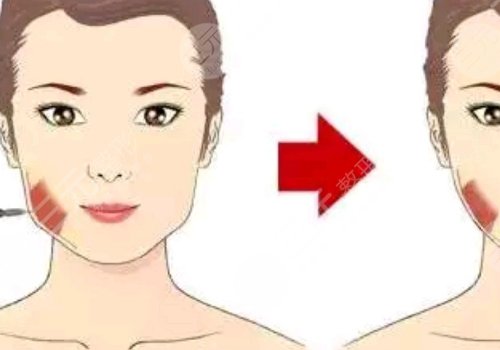 注射瘦臉會(huì)反彈嗎？