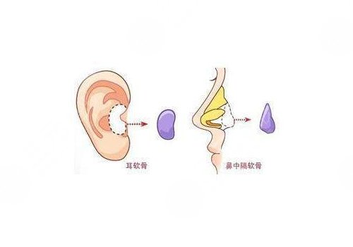 隆鼻假體取出來后能恢復(fù)到以前嗎？