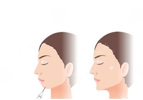 艾莉薇傳奇玻尿酸維持多久？