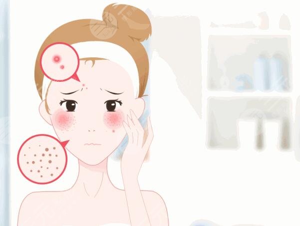 激光祛痘需要多長時間才能看到效果?