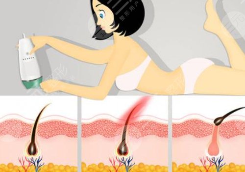 激光脫毛幾次能永久脫毛？