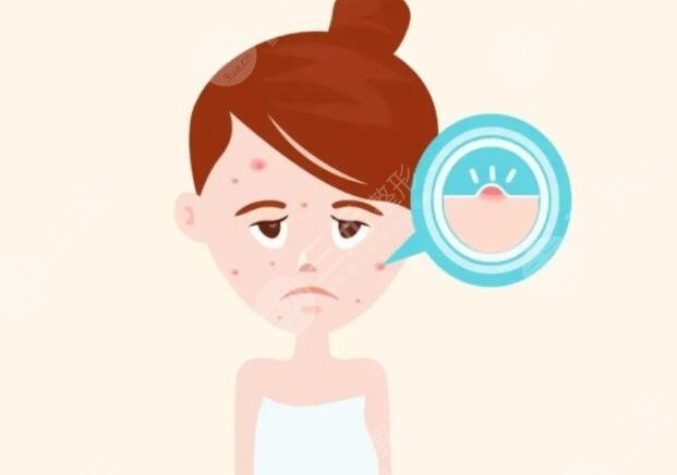 緩解青春痘的方法