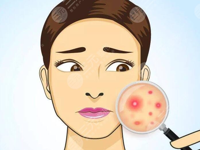 緩解青春痘時需要注意以下幾點：