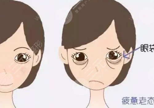 眼袋怎么消除？