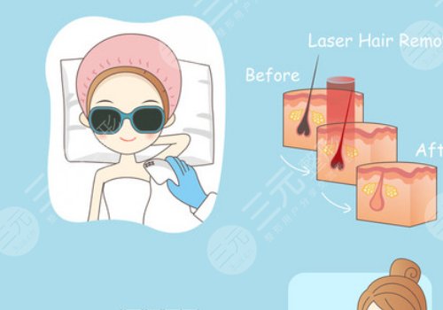 激光脫毛和冰點(diǎn)脫毛有什么區(qū)別？