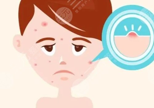 口周一直長(zhǎng)痘痘什么原因？