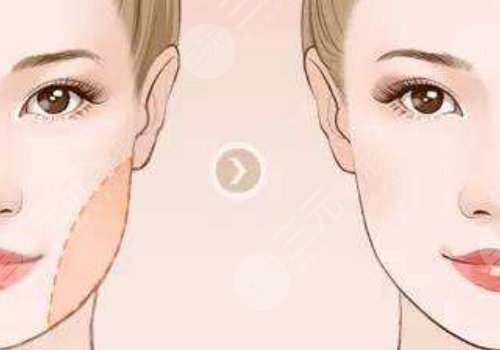 杭州時(shí)光下頜角磨骨怎么樣?