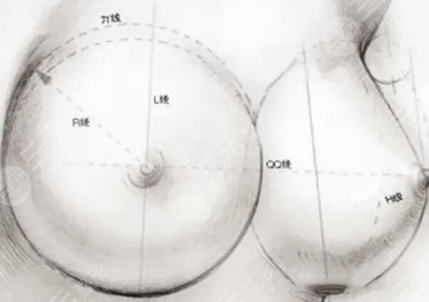 隆胸失敗修復(fù)