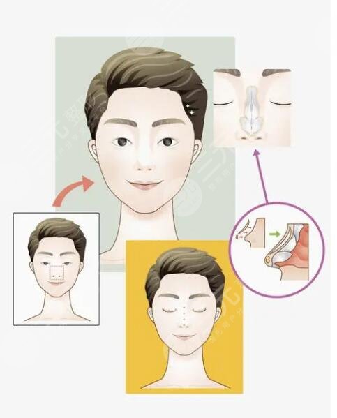 李愛林做鼻子怎么樣？醫(yī)生資料詳情、手術風格夸張嗎？整友術后反饋來襲~