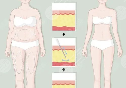 如何減去腹部贅肉？