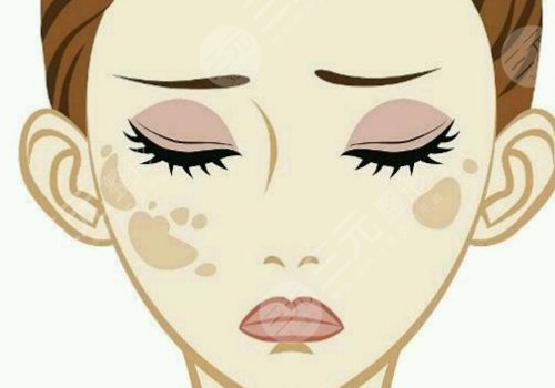 臉上長(zhǎng)了色斑是什么原因造成的?