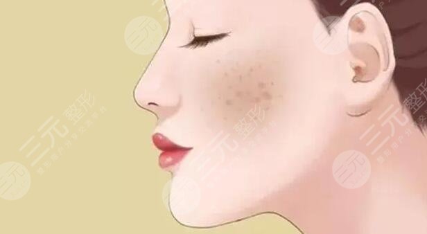 去除黃褐斑價格是多少？怎么預防和減少黃褐斑的出現(xiàn)？