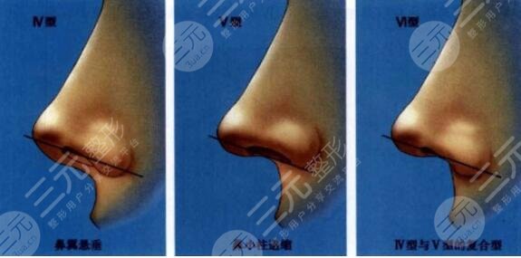 如何減少玻尿酸隆鼻的副作用?