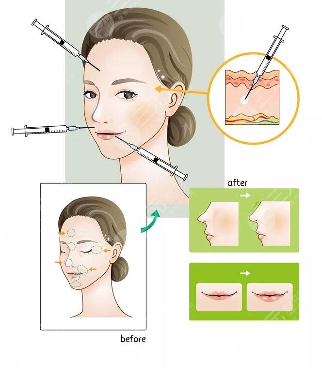 玻尿酸隆鼻的效果及注意事項(xiàng)