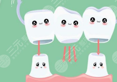 鈷鉻烤瓷牙套怎么樣？