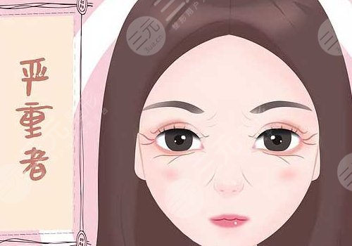 去魚尾紋手術(shù)多少錢呢？