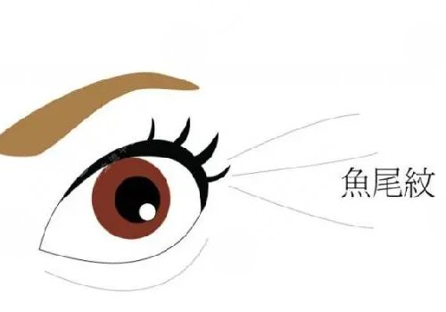 魚尾紋手術(shù)哪種好？