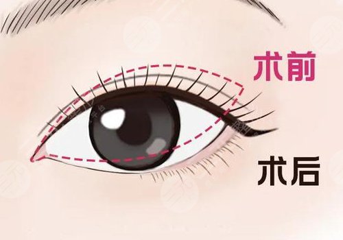 開眼角疼不疼呢？效果如何？