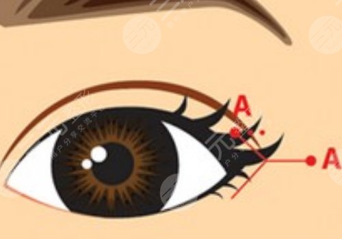 開眼角疼不疼呢？效果如何？