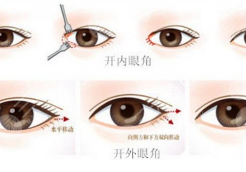 開眼角疼不疼呢？效果如何？