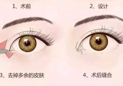 開眼角疼不疼呢？效果如何？