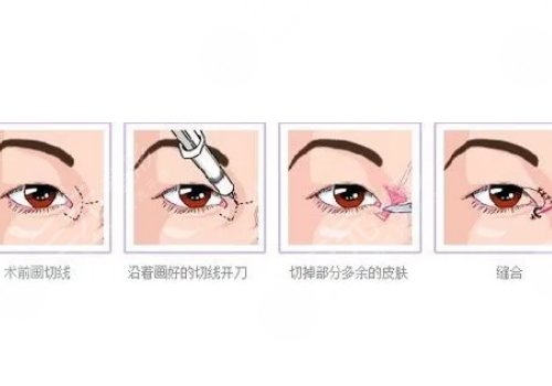 開眼角疼不疼呢？效果如何？