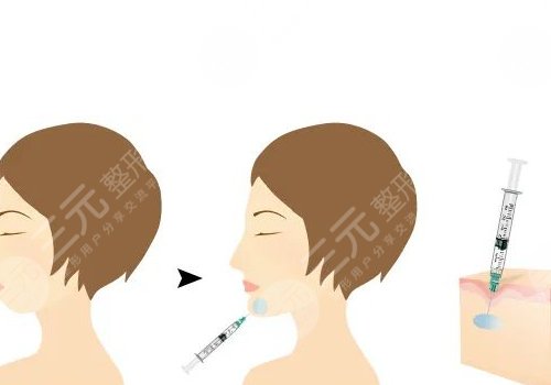 自體脂肪隆下巴多少錢？