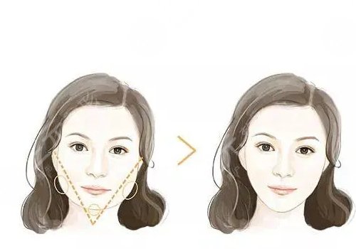 自體脂肪隆下巴多少錢？