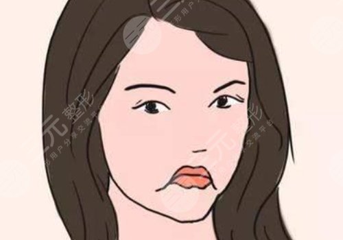 厚唇改薄能維持多久