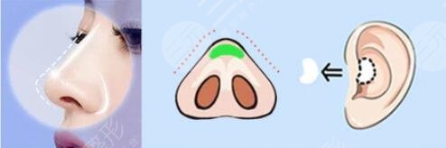 隆鼻整形手術(shù)