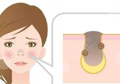 男性毛孔粗大油膩怎么改良？