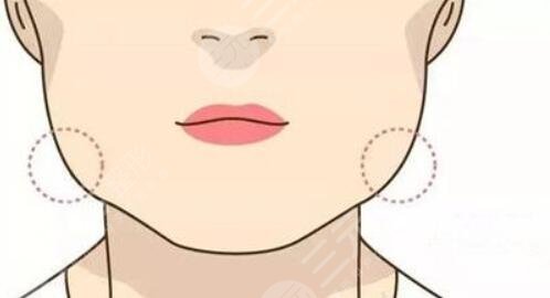 下頜角肥大怎么處理？有效的改良方式匯總，你適合哪種？