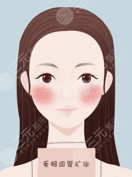 彩光祛紅血絲注意事項