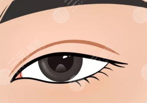 雙眼皮修復(fù)大概多少錢呢？