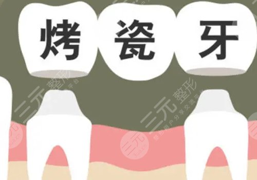 烤瓷牙多少錢一顆價格表2023