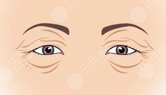 　　眼瞼皮膚松弛矯正術(shù)適合哪些人群?在開(kāi)展緩解之前，越來(lái)越多的人都咨詢(xún)過(guò)這個(gè)問(wèn)題，因?yàn)橥ㄟ^(guò)做該緩解，能夠讓眼部周?chē)募∧w更加的緊致和光滑，不會(huì)出現(xiàn)松弛的感覺(jué)，而且也能夠讓整個(gè)人的皮膚狀態(tài)看上去更加的美觀和協(xié)調(diào)。但是做完緩解之后也有可能會(huì)出現(xiàn)一些后遺癥，所以適用的人群是不同。那么，眼瞼皮膚松弛矯正術(shù)適合哪些人群?一起來(lái)看!  　　一、眼瞼皮膚松弛是什么?  　　上眼瞼松弛多由于上眼皮脂肪過(guò)多所致，整個(gè)人眼部周?chē)募∧w看上去是比較松弛的，沒(méi)有美觀的感覺(jué)。如果不進(jìn)行及時(shí)的緩解和改良的話，那么整個(gè)人的皮膚會(huì)變薄然后變松，整個(gè)人的肌膚彈性會(huì)越來(lái)越小，松弛的程度也會(huì)更加的嚴(yán)重，整個(gè)人體的皮膚也會(huì)產(chǎn)生一定的萎縮。  　　二、眼瞼皮膚松弛矯正術(shù)適合哪些人群?  　　矯正手術(shù)適合人群，其實(shí)是比較多元化的，而且并非單純從年齡角度考慮，主要是看人體的眼角以及眉毛的松弛程度，也要看外眥皮膚松弛情況、上瞼重瞼松弛情況，然后根據(jù)實(shí)際狀態(tài)制定針對(duì)性的手術(shù)方案，然后再判斷是否可以進(jìn)行矯正手術(shù)。  　　通過(guò)上瞼松弛矯正術(shù)，同時(shí)也可以通過(guò)眉上切口或眉下切口，能夠讓整個(gè)人的眼部協(xié)調(diào)感更好，同時(shí)能夠達(dá)到面部年輕化的效果，而且還能夠讓眼部周?chē)募∧w更加的緊致。隨著求美人士對(duì)面部美容的關(guān)注，這種緩解方式能夠讓受術(shù)者得到更好的調(diào)節(jié)，并且皮膚狀態(tài)也會(huì)更加的美觀。  　　1、上眼瞼松弛多見(jiàn)于中、老年人，所以說(shuō)這類(lèi)人群一般是比較適合的。隨著年齡的增長(zhǎng)，皮膚在慢慢的變薄，然后變得更加的松弛，所以說(shuō)肌膚也缺乏彈性，這類(lèi)人群的眼輪匝肌變性松弛、眼眶隔膜松弛萎縮，所以可以通過(guò)做該手術(shù)進(jìn)行一定的改良和調(diào)。  　　2、眼瞼松弛尤其是上眼瞼松弛這類(lèi)人群，也可以通過(guò)做這類(lèi)緩解，進(jìn)行一定的調(diào)節(jié)。嚴(yán)重的引起瞼裂變小，從而導(dǎo)致遮蓋瞳孔而影響視力影響視野，因此進(jìn)行一定的改良，能夠讓肌膚更加的緊致，而且也能夠讓生活更加的方便。有的可見(jiàn)倒睫毛刺激眼球引起不適，通過(guò)做該手術(shù)可以更好的改良。眼瞼松弛影響美觀，也影響視野，所以做了這類(lèi)緩解之后，皮膚也會(huì)更加的緊致，皺紋也會(huì)越來(lái)越少。  　　三、眼瞼皮膚松弛矯正術(shù)注意事項(xiàng)  　　上眼瞼松弛影響美觀影響視野，可以在專(zhuān)業(yè)醫(yī)生的指導(dǎo)下做手術(shù)進(jìn)行一定的調(diào)節(jié)，但是一定要進(jìn)行術(shù)前的檢查然后根據(jù)自己的實(shí)際狀態(tài)進(jìn)行操作。手術(shù)后遵從醫(yī)囑，及時(shí)使用抗炎藥物，不能夠吃太多辛辣刺激性以及油膩的食物，避免感染發(fā)生，定期眼科檢查，如果出現(xiàn)了問(wèn)題也要進(jìn)行及時(shí)的緩解，而且傷口不能夠沾水，否則可能也會(huì)出現(xiàn)感染的。  　　做完緩解之后不能夠用力按壓自己肌膚，否則有可能會(huì)出現(xiàn)劇烈的疼痛感，還有可能會(huì)出現(xiàn)炎癥的現(xiàn)象，因此一定要進(jìn)行針對(duì)性的護(hù)理，才能夠讓整個(gè)人的眼部周?chē)募∧w更加的緊致，一旦出現(xiàn)了松弛，就要進(jìn)行及時(shí)的干預(yù)和改良。日常生活中也要早一點(diǎn)休息，盡量減少熬夜，才能夠讓整個(gè)人的皮膚更加的健康。在熬夜的過(guò)程中，可能會(huì)出現(xiàn)內(nèi)分泌系統(tǒng)失調(diào)，周?chē)募∧w狀態(tài)也會(huì)更加的衰老，還有可能會(huì)出現(xiàn)皺紋加重的現(xiàn)象，因此一定要早睡早起，調(diào)節(jié)好生活作息時(shí)間。