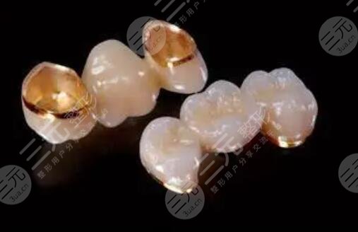 全瓷牙價格影響的因素