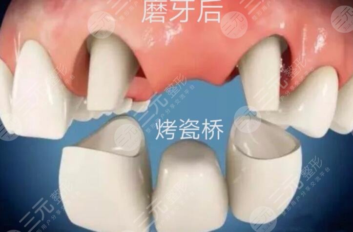 全瓷牙價格影響的因素