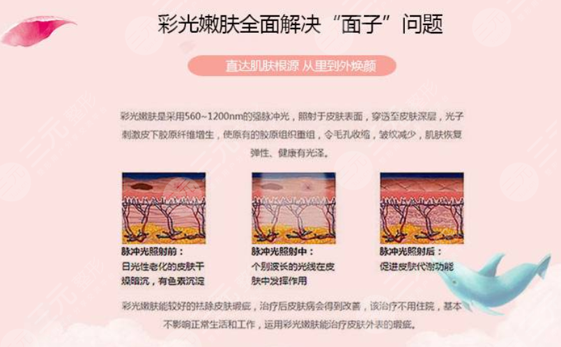 彩光嫩膚的緩解原理