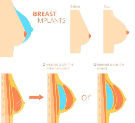 假體琴面跟光面有啥區(qū)別？