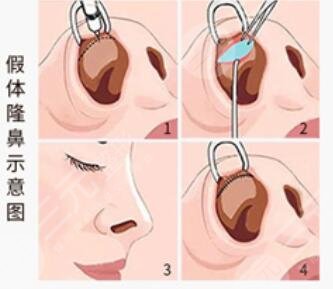 假體隆鼻后假體外露怎么辦?