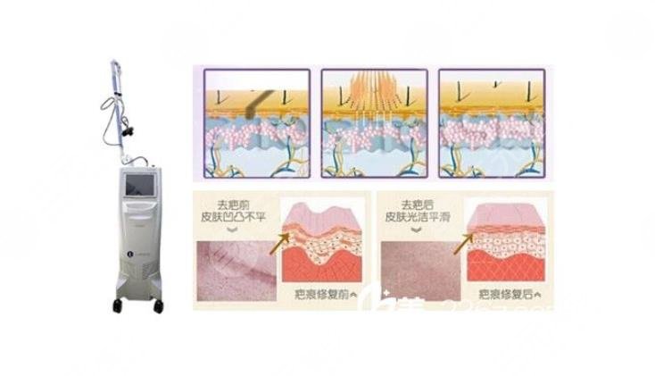 有傷疤怎么去掉？