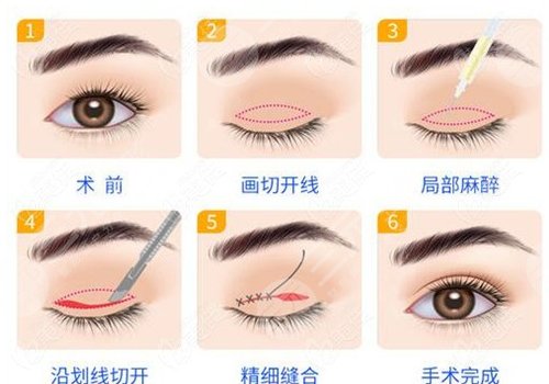 切雙眼皮多久能恢復(fù)自然？