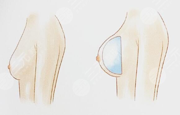 魔滴假體隆胸之后多久能夠變?nèi)彳?