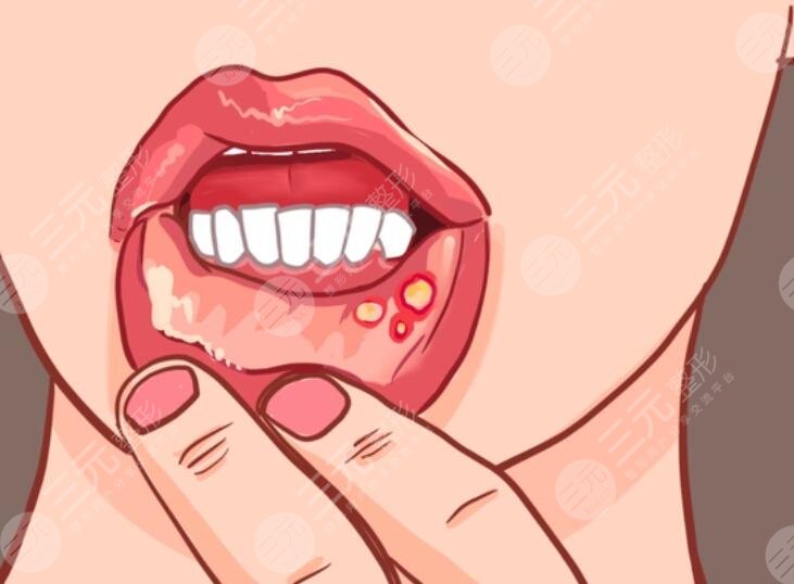 口腔潰瘍需要注意事項有哪些?