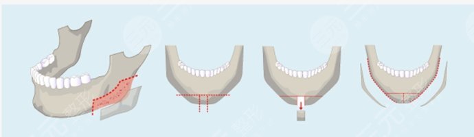 下頜角寬大怎么改良？