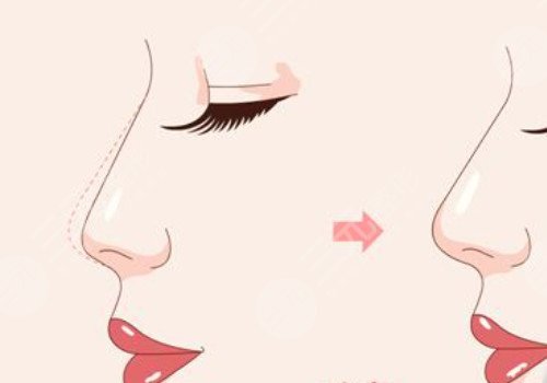 媽生鼻和直鼻微翹的區(qū)別是什么？